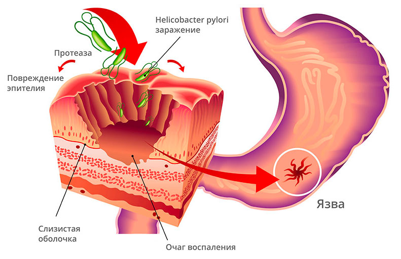 Прикрепление h pylori к стенке желудка
